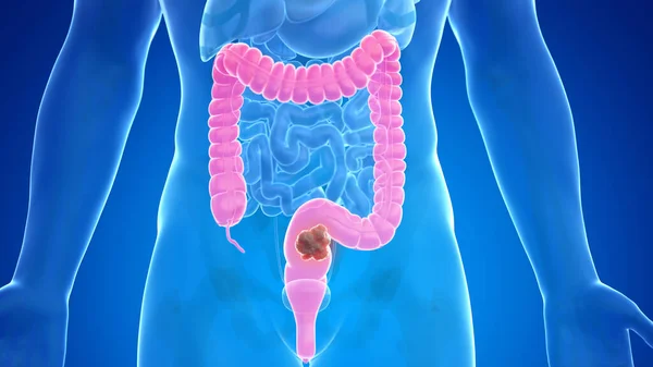 青を背景にした結腸がん イラスト — ストック写真