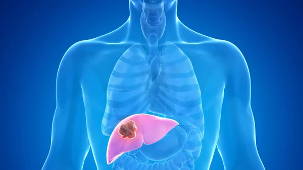 Liver Cancer Blue Background Illustration — Stock Photo, Image