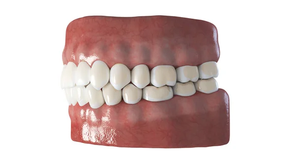 Zubní Demineralizace Izolované Bílém Pozadí — Stock fotografie