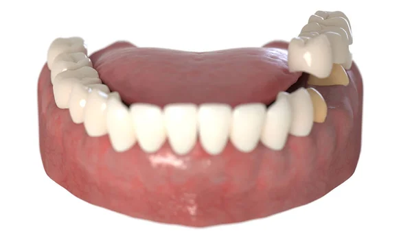 Gebrochener Zahn Isoliert Auf Weißem Hintergrund Illustration — Stockfoto