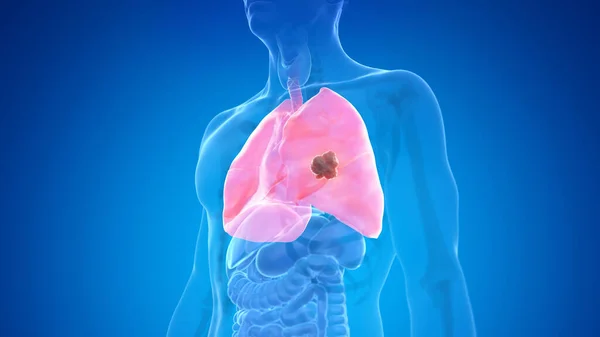 蓝色背景的肺癌 — 图库照片