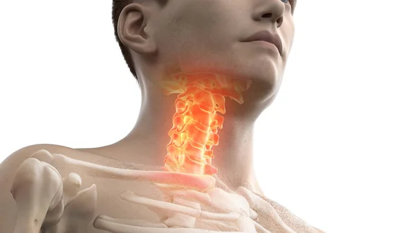 Painful Cervical Spine Illustration — Stock Photo, Image