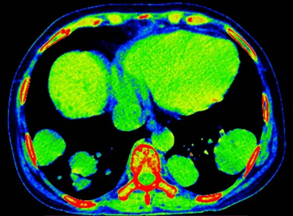 Цветная Осевая Компьютерная Томография Грудной Клетки Летней Женщины Коротким Дыханием — стоковое фото