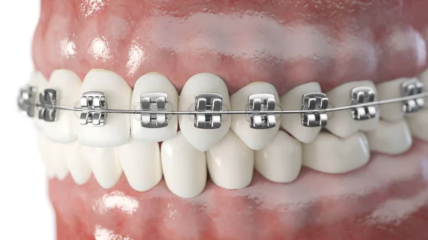 Bretelle Dentali Isolate Sfondo Bianco Illustrazione — Foto Stock