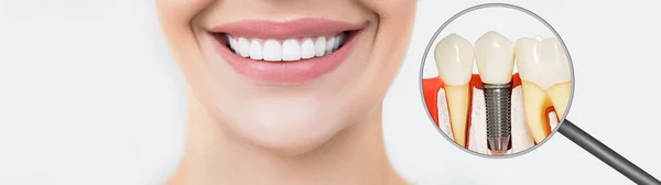 Dental Implant Composite Image — Stock Photo, Image