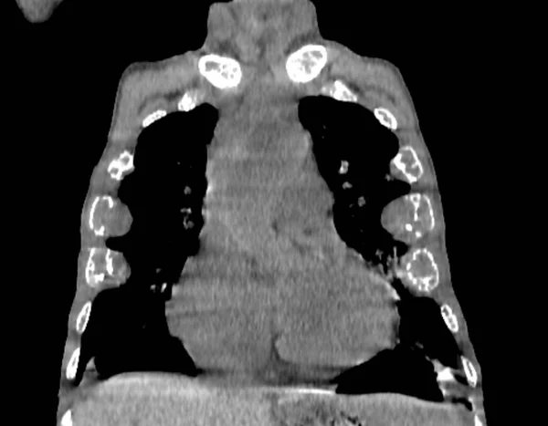 冠心病合并地中海贫血患者胸部冠状计算机断层扫描 双侧后纵隔肿块与前排和后排的髓质扩张有关 髓外血肿I — 图库照片