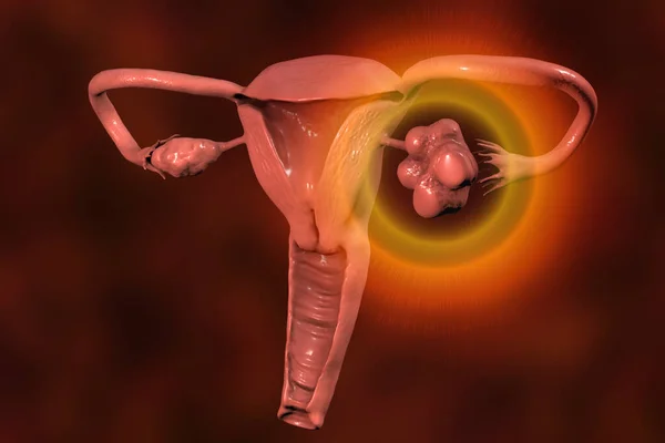 Síndrome Ovario Poliquístico Ilustración Por Ordenador Que Muestra Ovario Sano — Foto de Stock