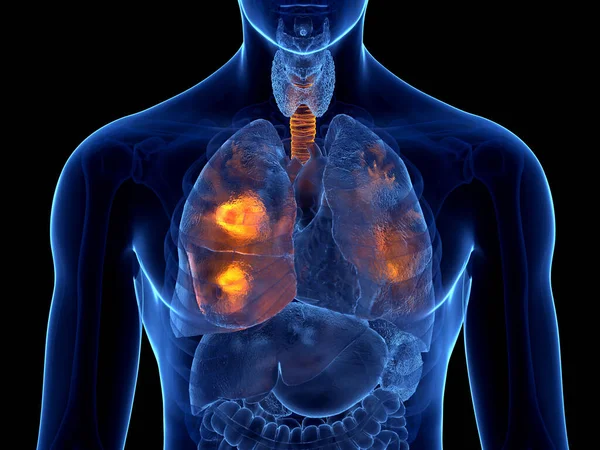 Lungenkrebs Begriffliche Illustration — Stockfoto
