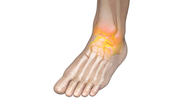 Painful Ankle Joint Illustration — Stock Photo, Image