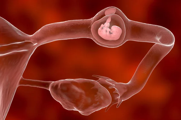 Gravidanza Ectopica Illustrazione Questa Una Gravidanza Cui Embrione Impianta All — Foto Stock