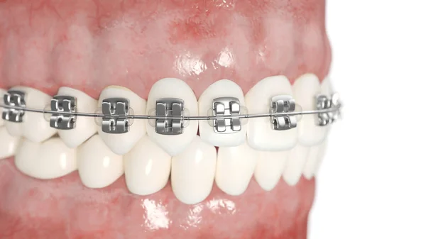 Dental Braces Isolated White Background Illustration — Stock Photo, Image