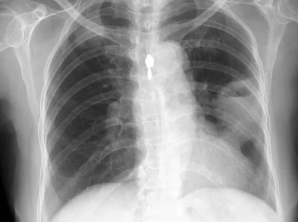 Röntgenaufnahme Der Brust Einer Jährigen Frau Mit Husten Die Eine — Stockfoto