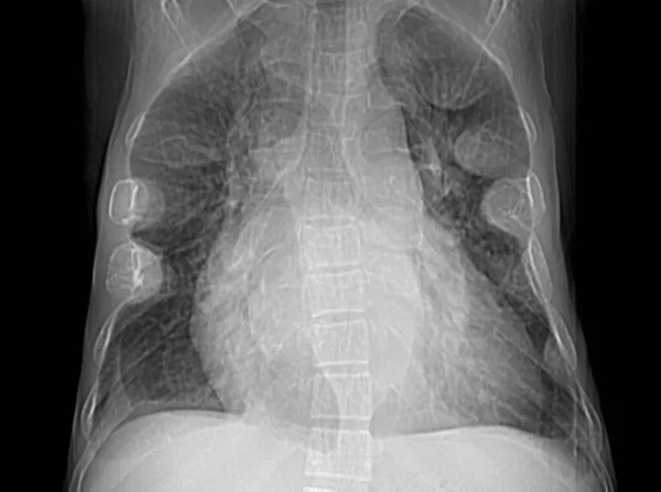 Radiographie Thoracique Patient Atteint Thalassémie Existe Des Masses Médiastinales Postérieures — Photo