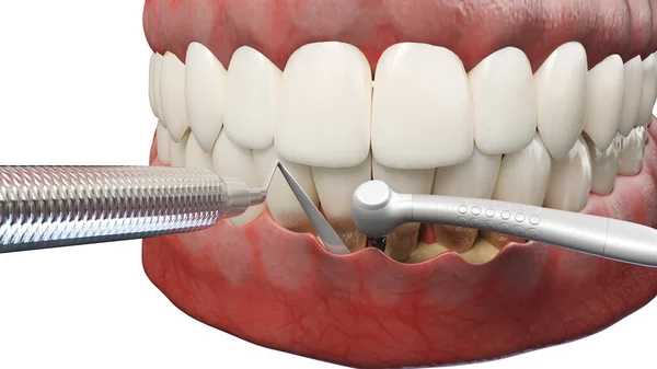 Reducción Bolsillo Dental Ilustración — Foto de Stock