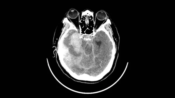 Tomodensitométrie Axiale Tdm Accident Vasculaire Cérébral Hémorragique Chez Une Patiente — Photo