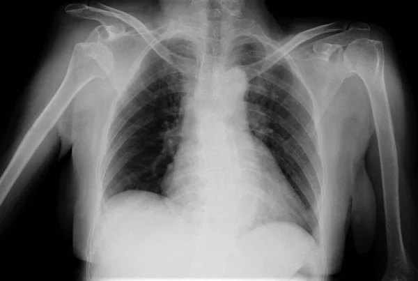 Radiographie Montrant Une Épaule Disloquée Tête Humérus Est Détachée Articulation — Photo