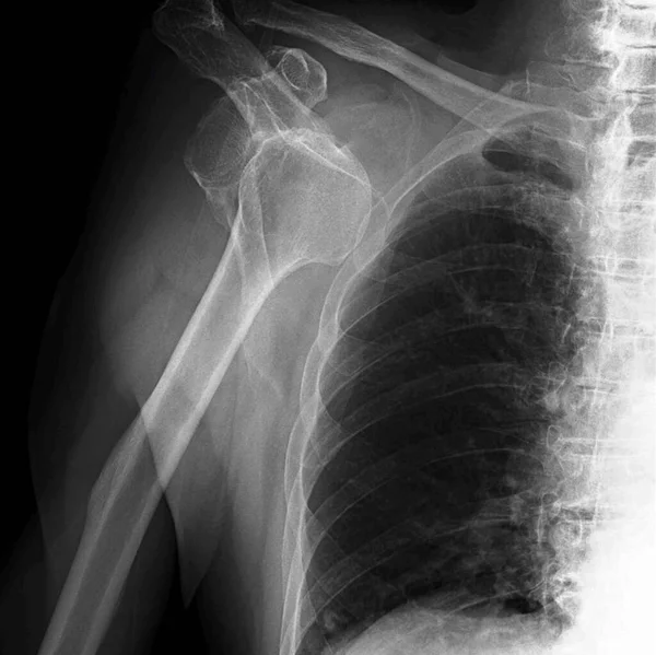 Radiografia Mostrando Ombro Deslocado Onde Cabeça Úmero Destacada Articulação Ombro — Fotografia de Stock