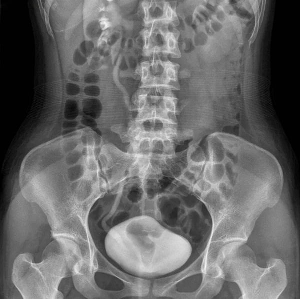 Urografía Intravenosa Radiografía Minutos Una Mujer Años Con Dolor Abdominal —  Fotos de Stock