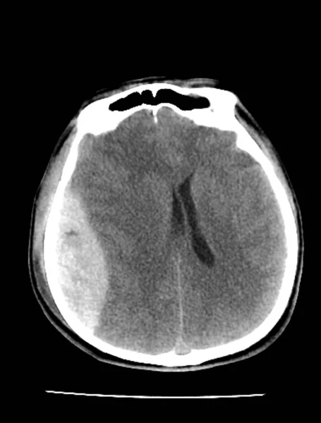 脑外伤 Ct扫描 — 图库照片