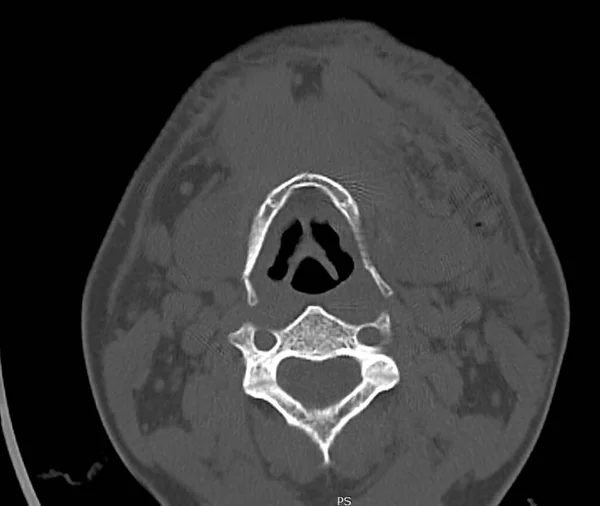 Комп Ютерна Томографія Сканування Шиї Річного Пацієнта Чоловічої Статі Переломами — стокове фото