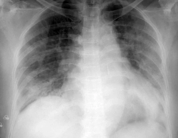 Röntgenbild Der Brust Eines Covid Lungenentzündungspatienten Mit Konsolidierung Trübung Beiden — Stockfoto