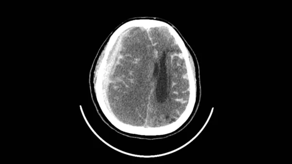 65歳の女性患者における出血性脳卒中の軸計算断層撮影 スキャン 目に見えるのは 脳内血腫 Ich 心室性血腫 Ivh 心室性血腫 Sdh Subarachnoid出血 — ストック写真
