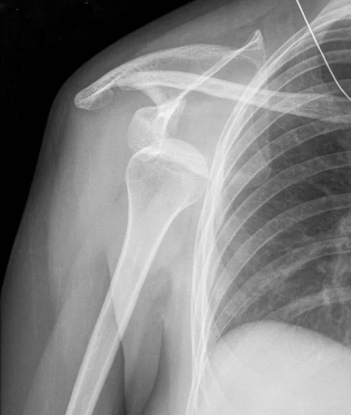 Radiografia Mostrando Ombro Deslocado Onde Cabeça Úmero Destacada Articulação Ombro — Fotografia de Stock