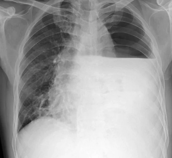 胸部X光检查一位带有气胸的病人 他有咳嗽症状 X光片显示出均匀的不均匀性 — 图库照片