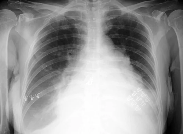 Chest Ray Year Old Female Patient Showing Heart Enlargement Cardiomegaly — Stock Photo, Image