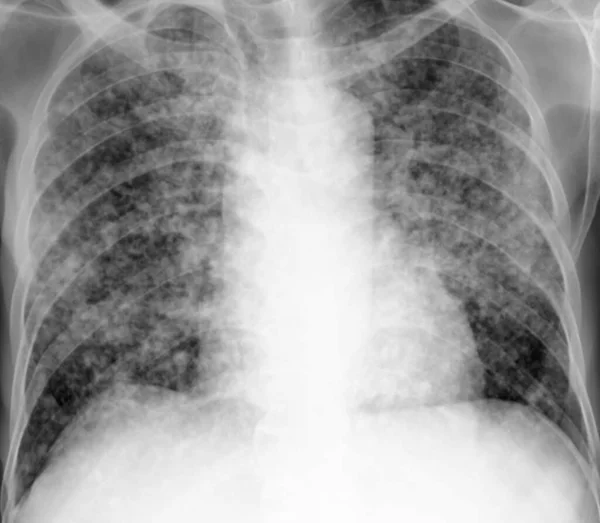 Radiographie Pulmonaire Patient Avec Nodules Miliaires Militaire Réfère Innombrables Petits — Photo