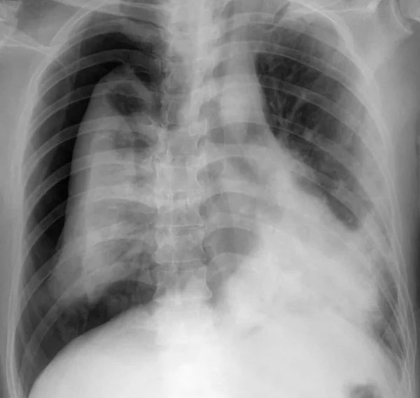 胸部X光显示胸部气胸 右半身有明显的空隙 — 图库照片