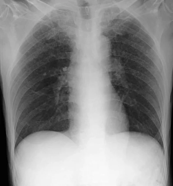軍事ノードを有する患者のX線 ミリタリーとは 肺全体にわたる無数の小さな肺結節を指す — ストック写真