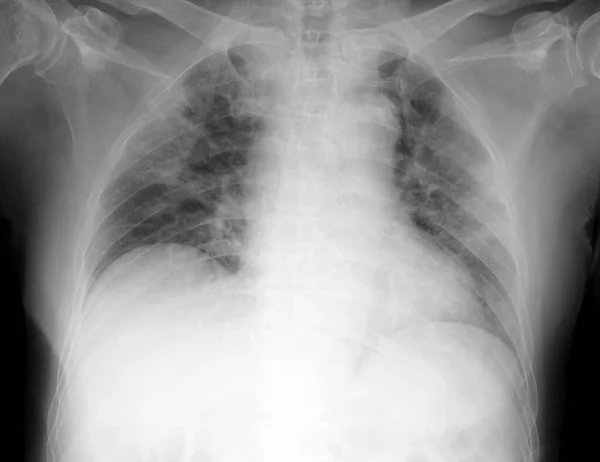 Rtg Klatki Piersiowej Pacjenta Zapaleniem Płuc Typu Covid Wykazującym Wzmocnienie — Zdjęcie stockowe
