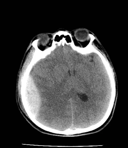 Травматические Повреждения Мозга Компьютерная Томография — стоковое фото