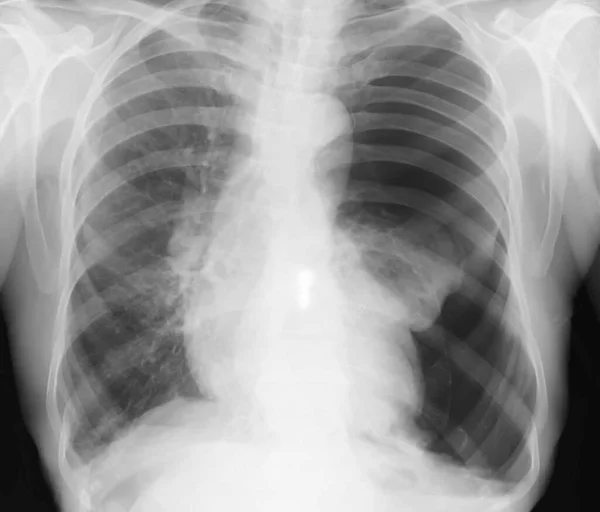 Ray Chest Showing Left Pneumothorax Clear Space Left Hemithorax — Stock Photo, Image