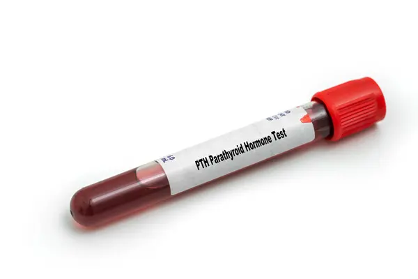 Parathyroid Hormone Test Conceptual Image — Stock Photo, Image