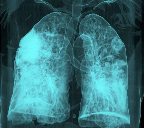 肺の両方の多細胞性を示すCovid 19肺炎患者の胸の3Dコンピュータ断層撮影 スキャン — ストック写真