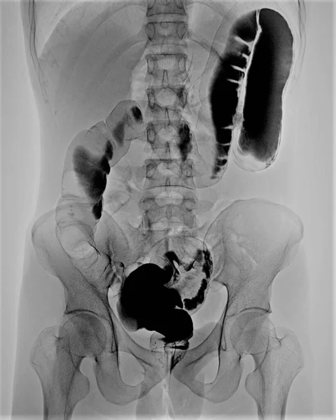 40岁复发性腹痛患者的对比钡灌肠X线表现为肠道反转和结肠反转 — 图库照片