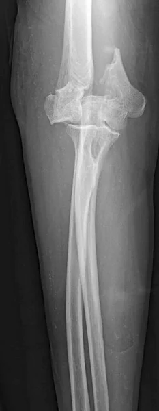 Ray Supracondylar Humerus Upper Arm Bone Fracture — Stock Photo, Image