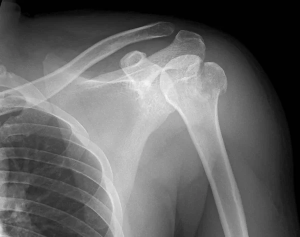 Рентген Проксимального Перелома Плечевой Кости Проксимальные Переломы Плечевой Кости Являются — стоковое фото