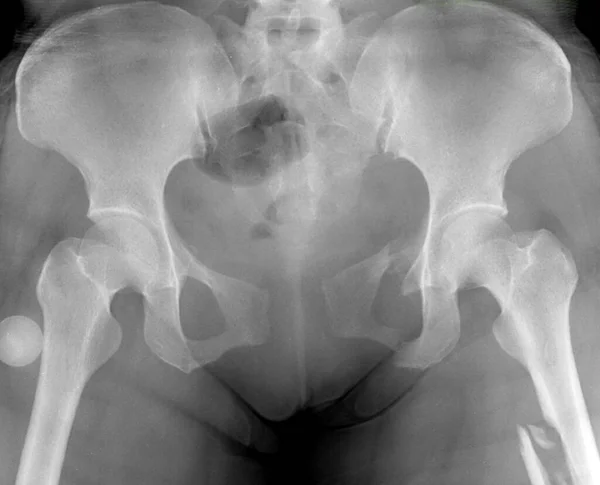 Radiografía Pelvis Paciente Que Tuvo Accidente Tráfico Radiografía Muestra Diastasis —  Fotos de Stock