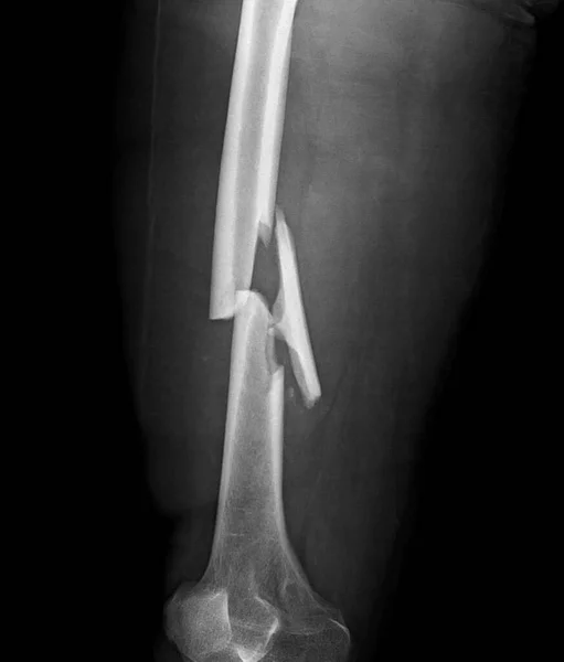 Rozdrobnione Złamanie Kości Udowej Rentgen — Zdjęcie stockowe