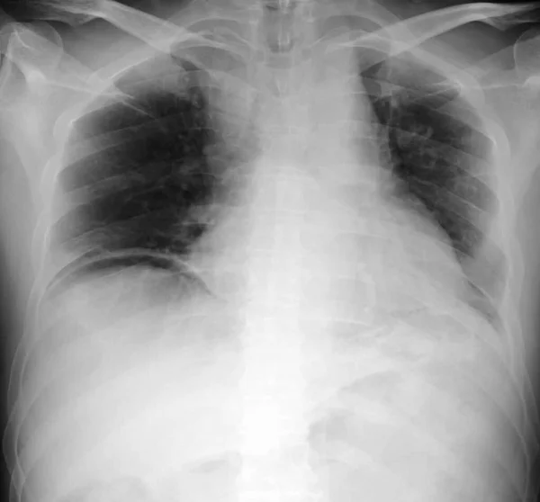 Radiografia Tórax Paciente Com Forma Crescente Lesão Radiolucente Sob Diafragma — Fotografia de Stock