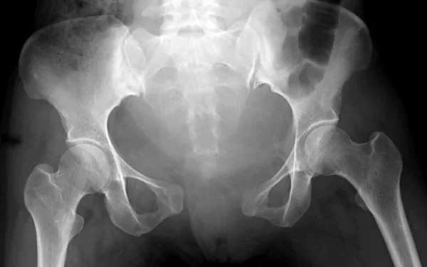 Radiografía Pelvis Una Mujer Después Del Parto Que Muestra Diastasis —  Fotos de Stock