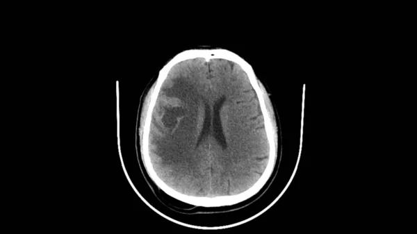1例55岁肺癌及左侧体弱患者的Ct扫描显示右脑囊性肿块 提示脑转移 — 图库照片