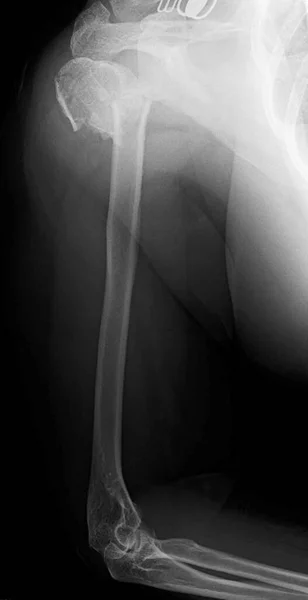 Рентген Проксимального Перелому Плечової Кістки Проксимальні Переломи Плечової Кістки Поширені — стокове фото