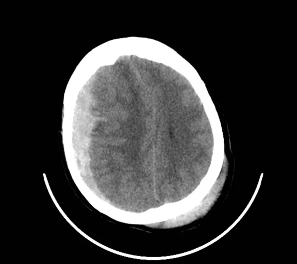 道路交通事故致严重脑外伤的32岁男性患者脑Ct扫描 — 图库照片