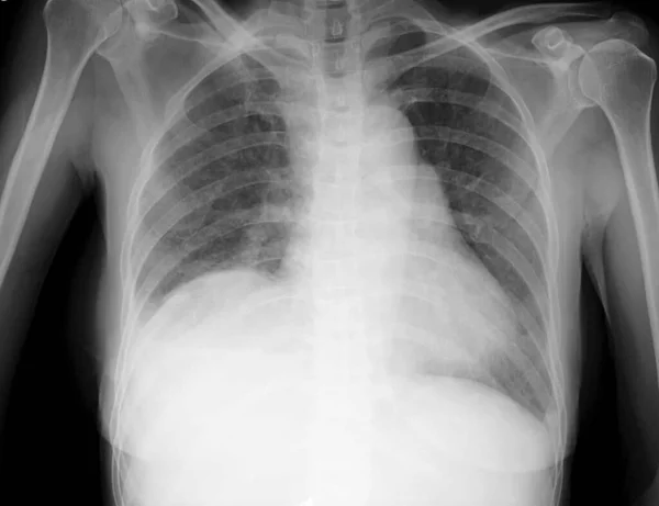 환자의 엑스레이 사진이에요 모양체는 폐전체에 폐포를 — 스톡 사진