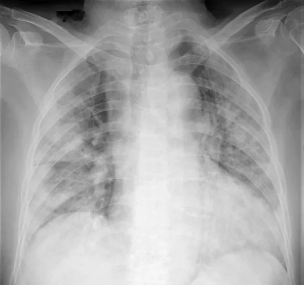 肺の統合 不透明度 を示すCovid 19肺炎患者の胸を示すX線 — ストック写真