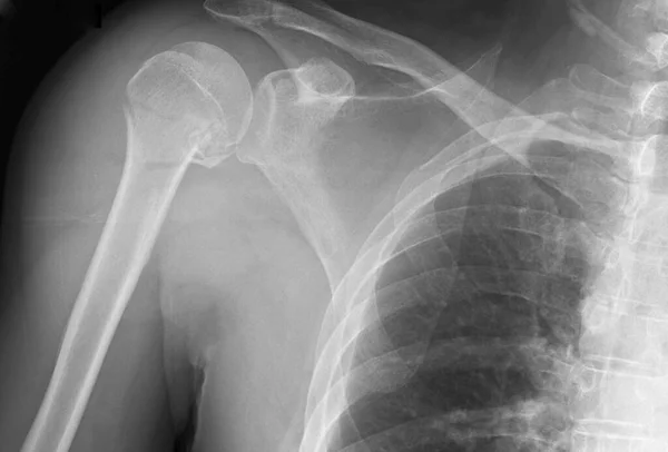Röntgenbild Eines Proximalen Oberarmknochenbruchs Proximale Oberarmfrakturen Sind Häufige Frakturen Bei — Stockfoto